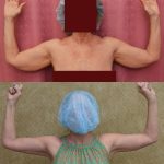Arm Lift (Brachioplasty) Before & After Patient #14261