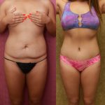 Tummy Tuck (Abdominoplasty) Medium Size Before & After Patient #14265