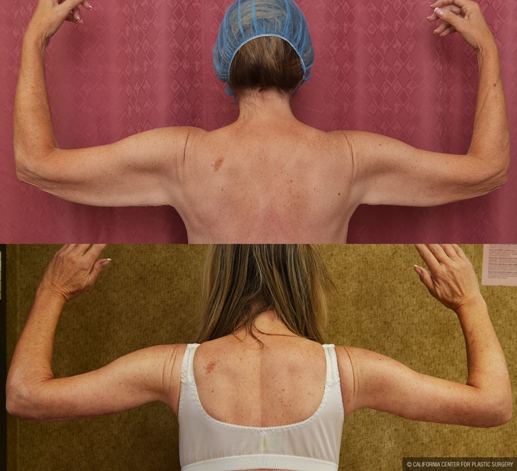 Arm Lift (Brachioplasty) Before & After Patient #14260