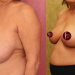Breast Reduction Before & After Patient #14259