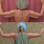Arm Lift (Brachioplasty) Before & After Patient #14261