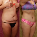 Tummy Tuck (Abdominoplasty) Medium Size Before & After Patient #14265