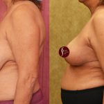 Breast Reduction Before & After Patient #14259