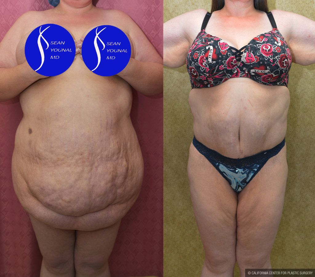 Tummy Tuck (Abdominoplasty) Super Plus Size Before & After Patient #14406