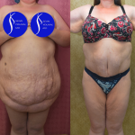 Tummy Tuck (Abdominoplasty) Super Plus Size Before & After Patient #14406