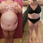 Liposuction Abdomen Plus Size Before & After Patient #14399
