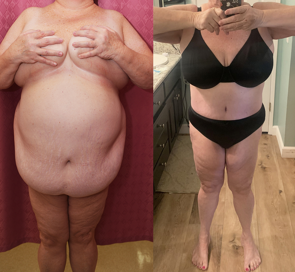 Liposuction Abdomen Plus Size Before & After Patient #14399