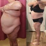 Liposuction Abdomen Plus Size Before & After Patient #14399