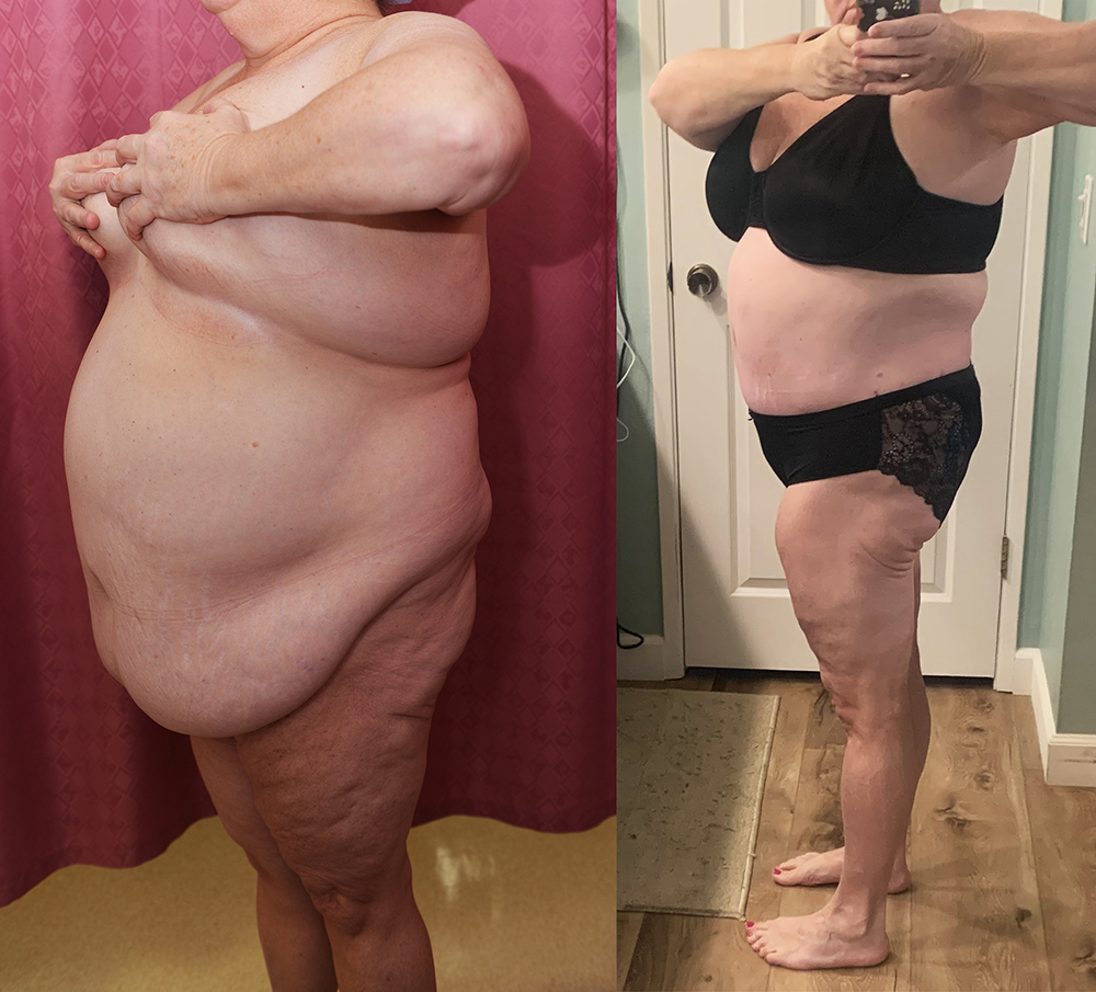 Liposuction Abdomen Plus Size Before & After Patient #14399