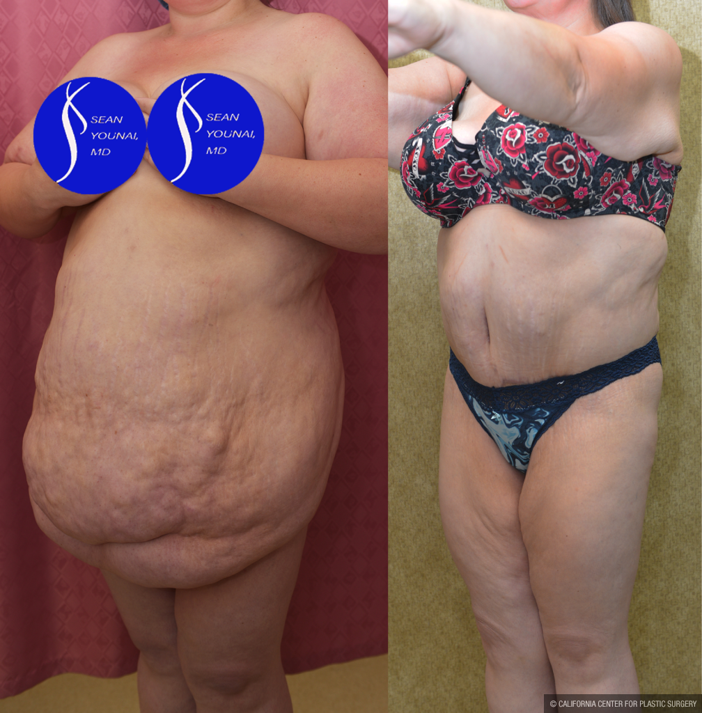 Tummy Tuck (Abdominoplasty) Super Plus Size Before & After Patient #14406
