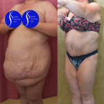 Tummy Tuck (Abdominoplasty) Super Plus Size Before & After Patient #14406