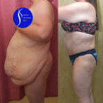 Tummy Tuck (Abdominoplasty) Super Plus Size Before & After Patient #14406