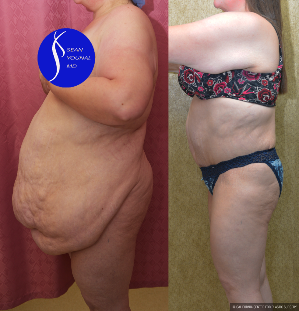 Tummy Tuck (Abdominoplasty) Super Plus Size Before & After Patient #14406