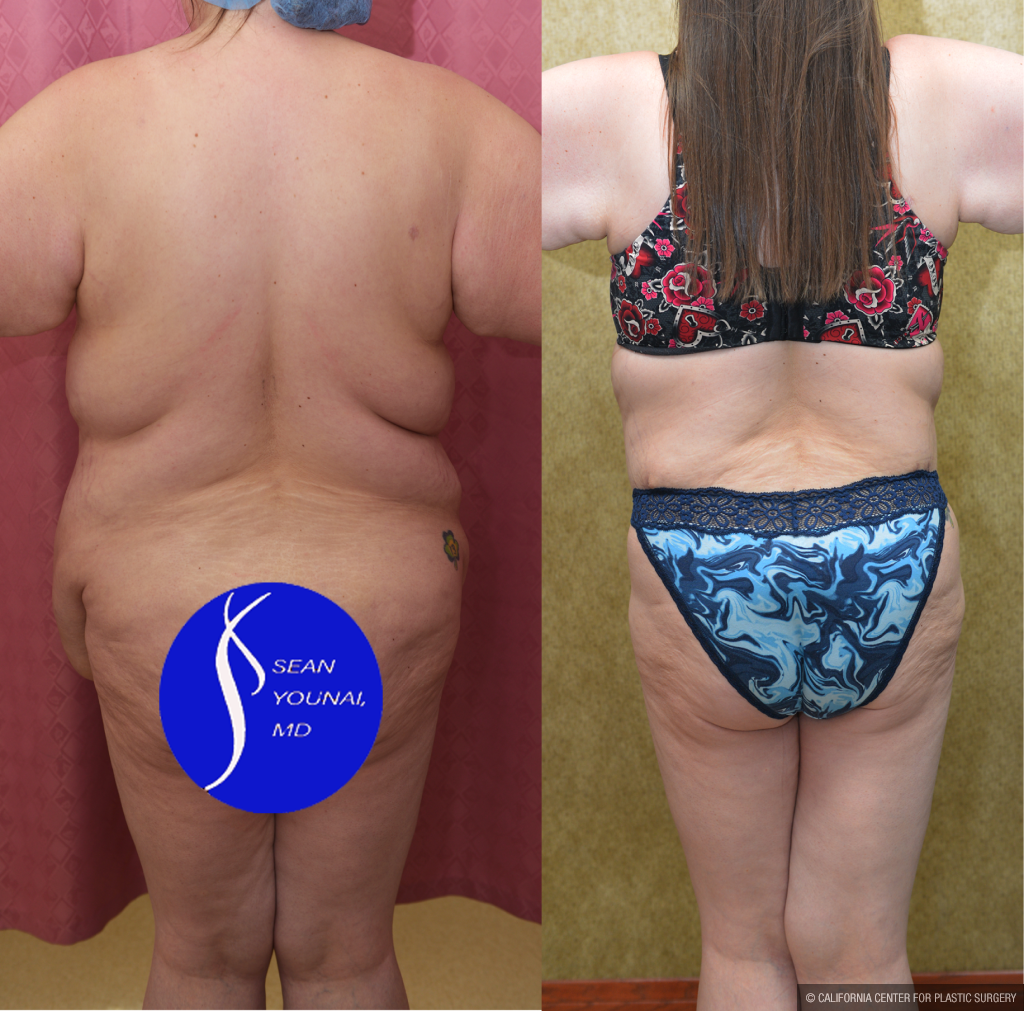 Tummy Tuck (Abdominoplasty) Super Plus Size Before & After Patient #14406
