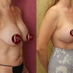 Breast Lift (Mastopexy) Before & After Patient #14400