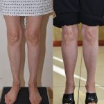 Calf Augmentation Before & After Patient #14401