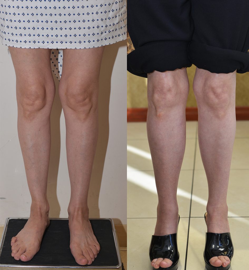Calf Augmentation Before & After Patient #14401