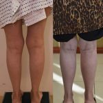 Calf Augmentation Before & After Patient #14401