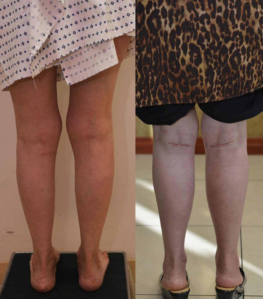 Calf Augmentation Before & After Patient #14401