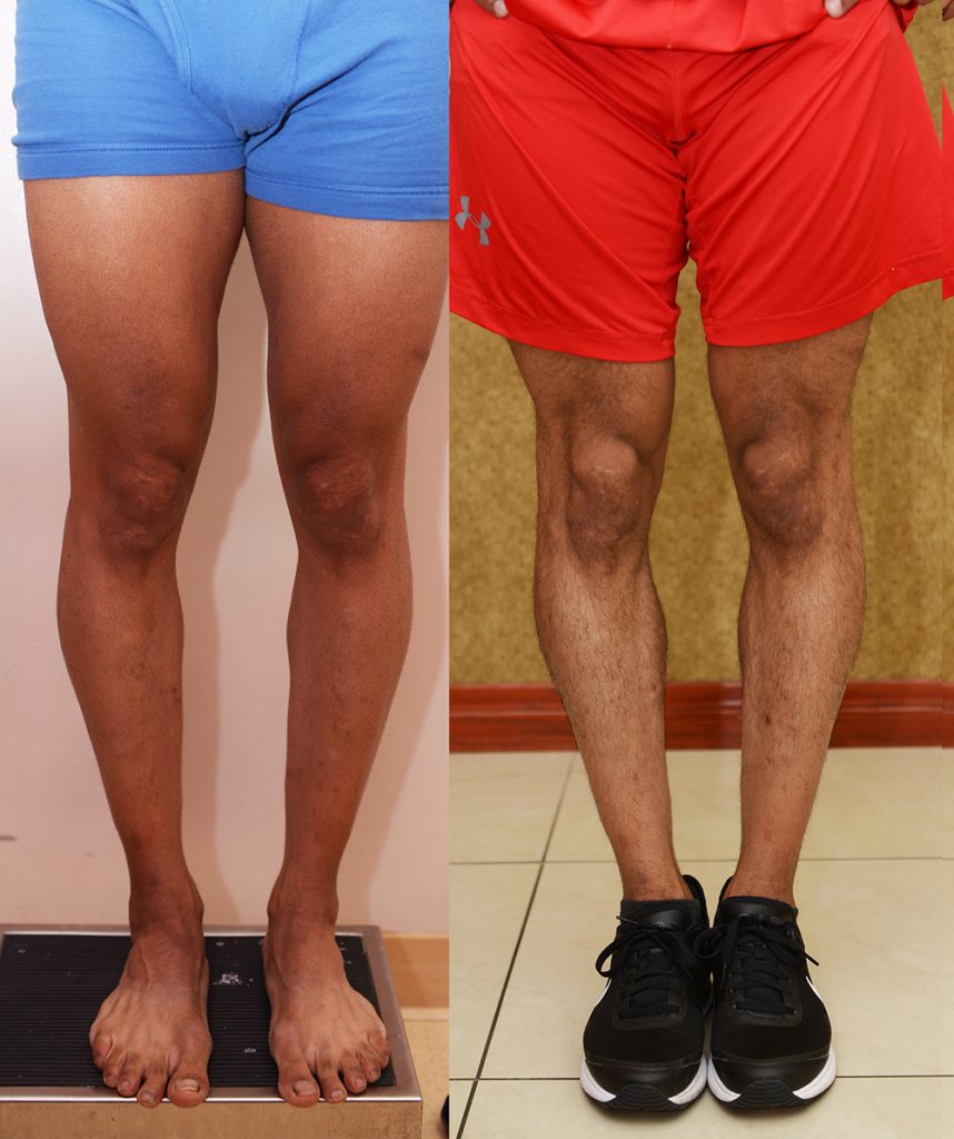 Calf Augmentation Before & After Patient #14402