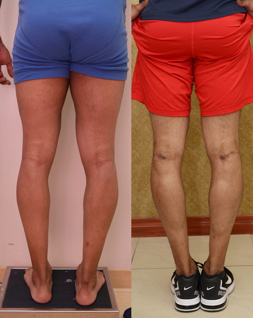 Calf Augmentation Before & After Patient #14402