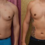 Male gynecomastia (breast) reduction Before & After Patient #14403