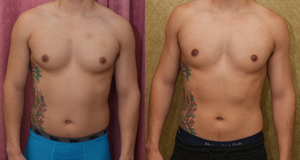 Male gynecomastia (breast) reduction Before & After Patient #14403