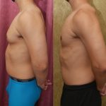 Male gynecomastia (breast) reduction Before & After Patient #14403