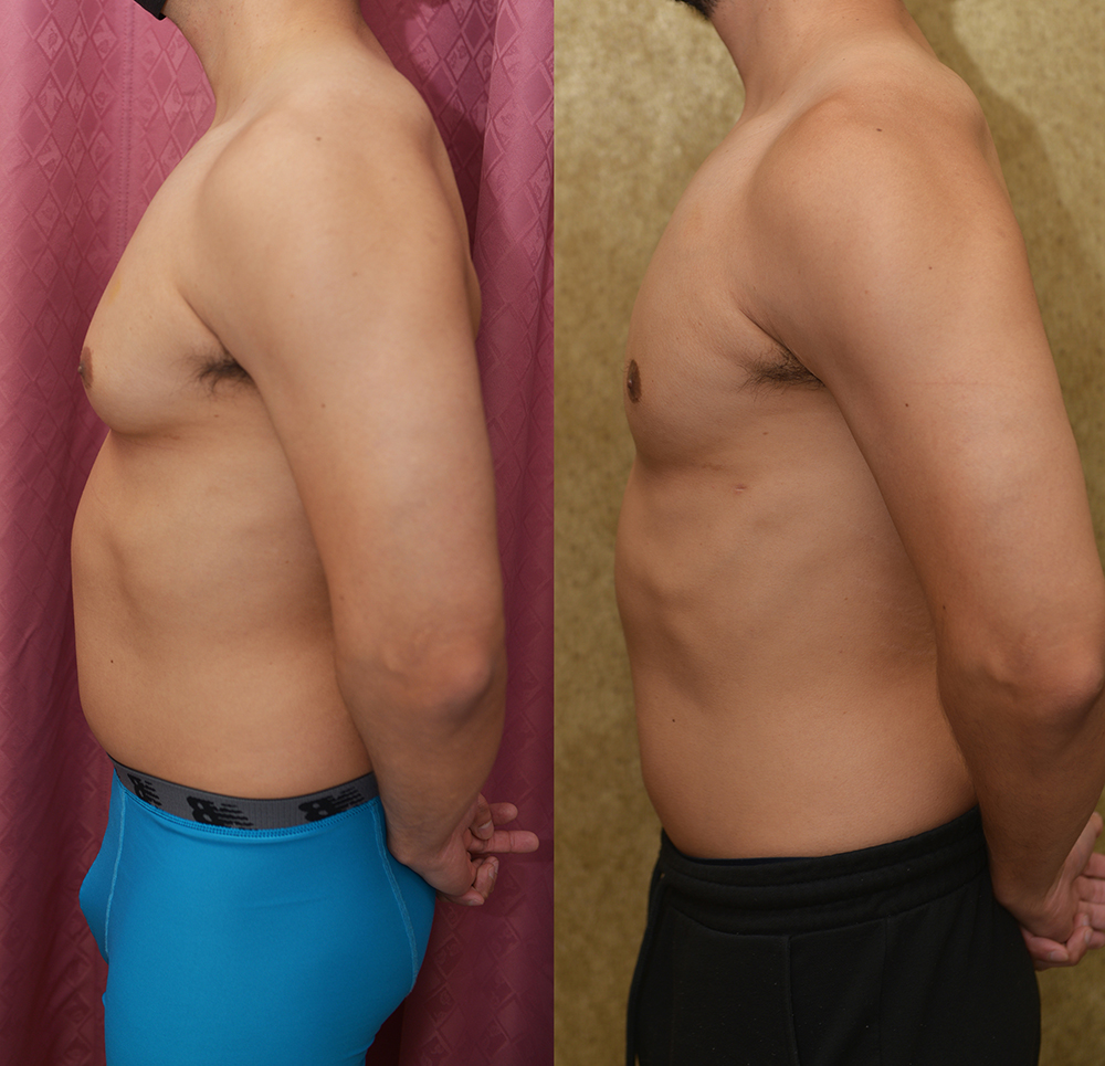 Male gynecomastia (breast) reduction Before & After Patient #14403