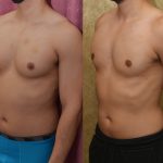 Male gynecomastia (breast) reduction Before & After Patient #14403