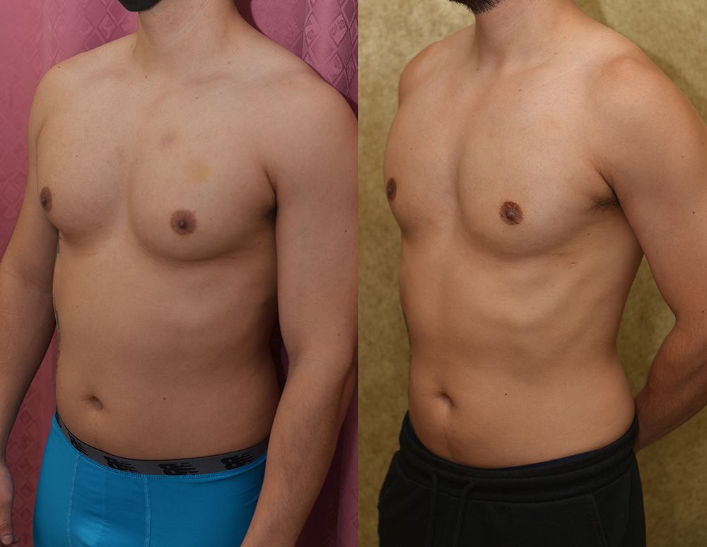 Male gynecomastia (breast) reduction Before & After Patient #14403