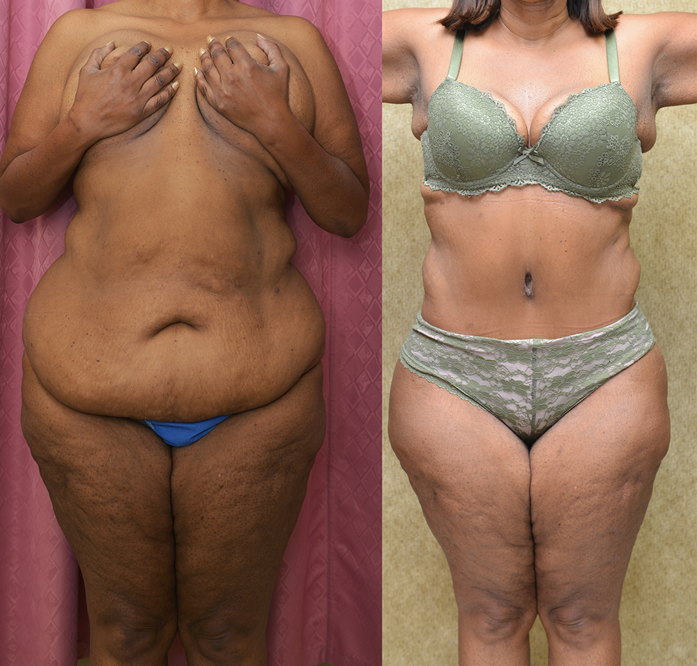 African American Tummy Tuck (Abdominoplasty) Before & After Patient #14404