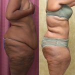 African American Tummy Tuck (Abdominoplasty) Before & After Patient #14404