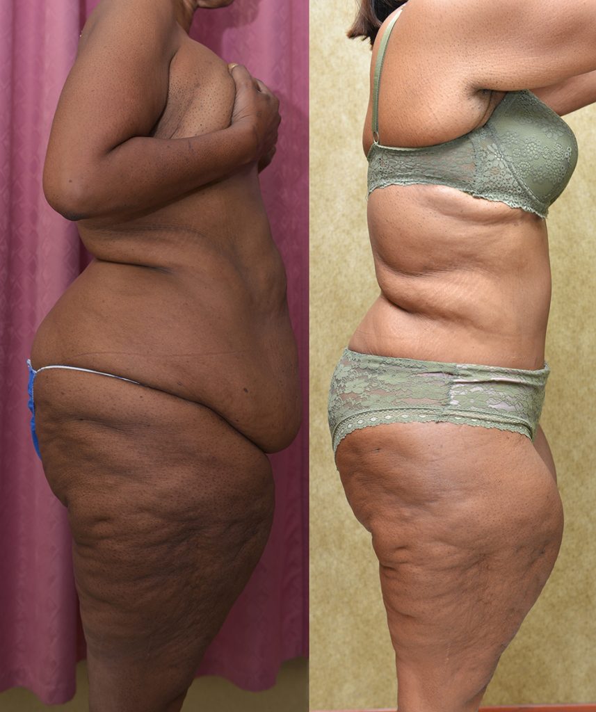 African American Tummy Tuck (Abdominoplasty) Before & After Patient #14404