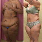 African American Tummy Tuck (Abdominoplasty) Before & After Patient #14404
