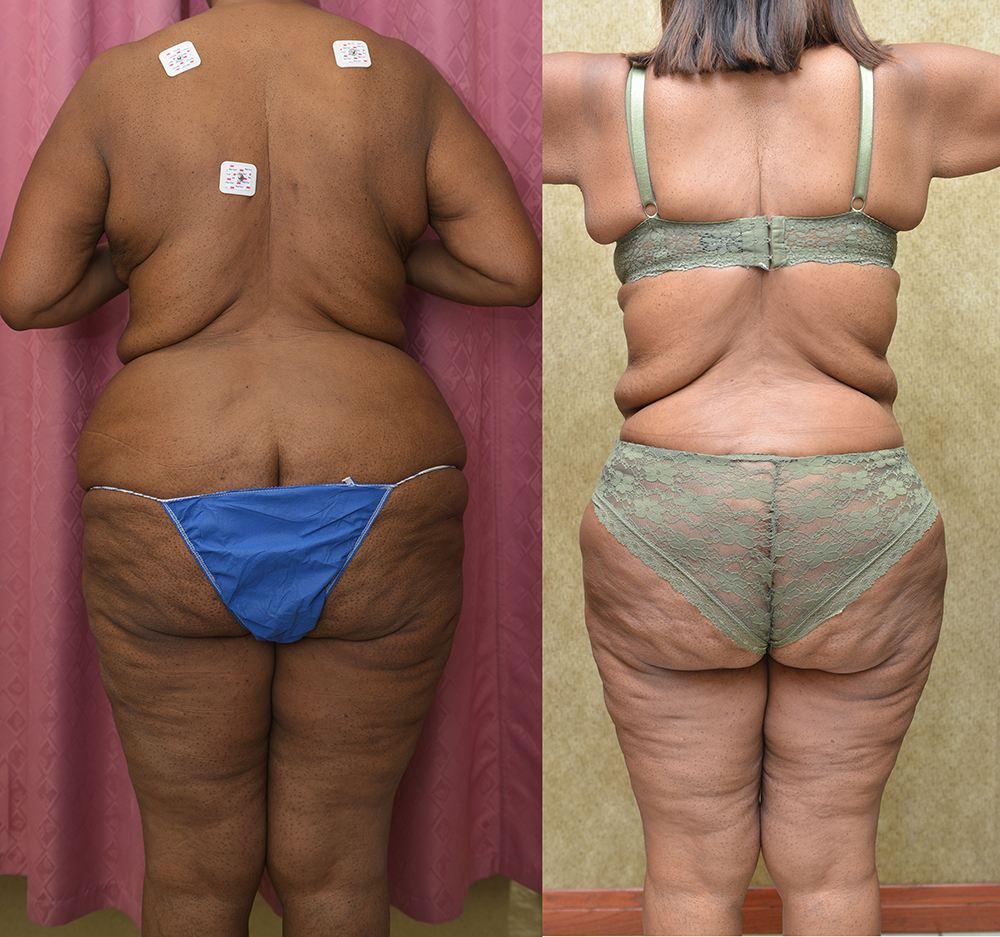 African American Tummy Tuck (Abdominoplasty) Before & After Patient #14404