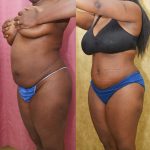 African American Tummy Tuck (Abdominoplasty) Before & After Patient #14405