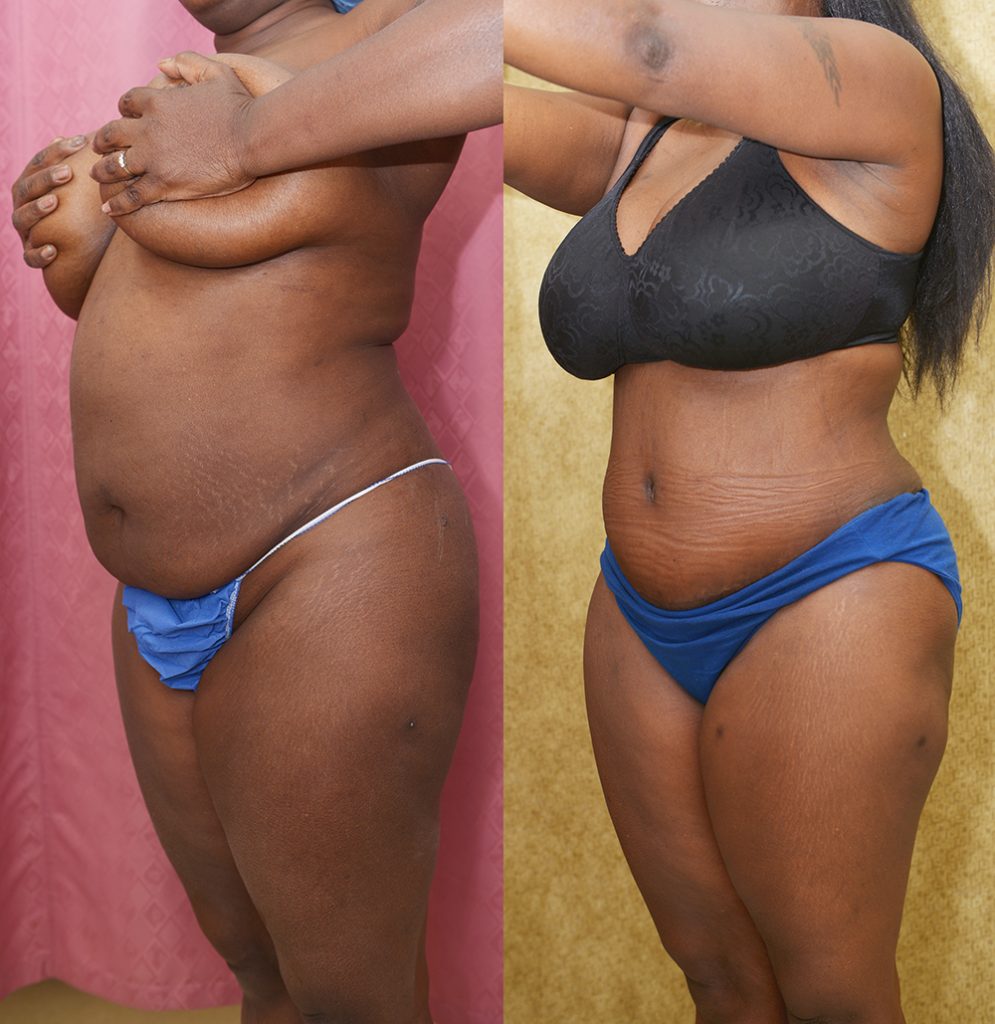 African American Tummy Tuck (Abdominoplasty) Before & After Patient #14405
