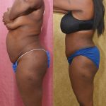 African American Tummy Tuck (Abdominoplasty) Before & After Patient #14405