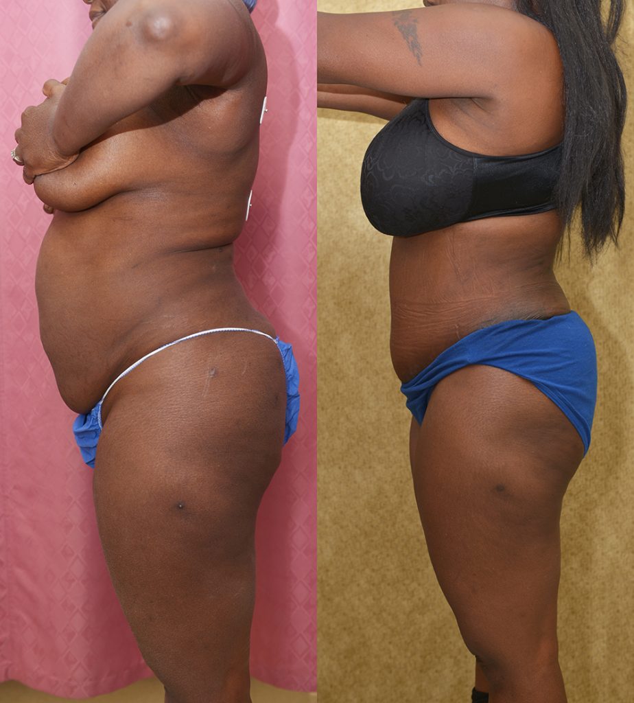 African American Tummy Tuck (Abdominoplasty) Before & After Patient #14405