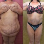 Tummy Tuck (Abdominoplasty) Super Plus Size Before & After Patient #14406