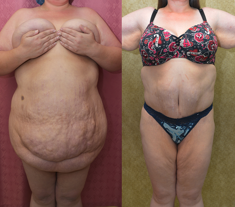 Tummy Tuck (Abdominoplasty) Super Plus Size Before & After Patient #14406