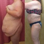 Tummy Tuck (Abdominoplasty) Super Plus Size Before & After Patient #14406