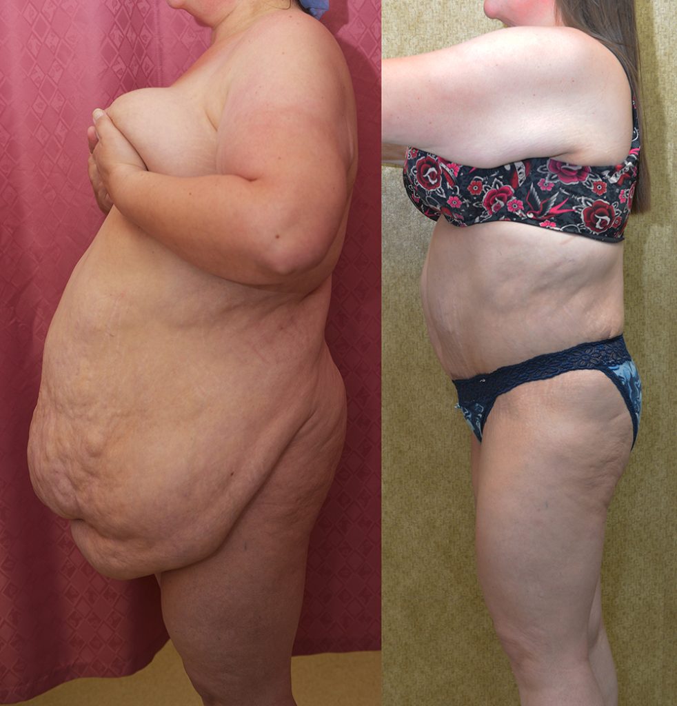 Tummy Tuck (Abdominoplasty) Super Plus Size Before & After Patient #14406