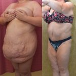 Tummy Tuck (Abdominoplasty) Super Plus Size Before & After Patient #14406