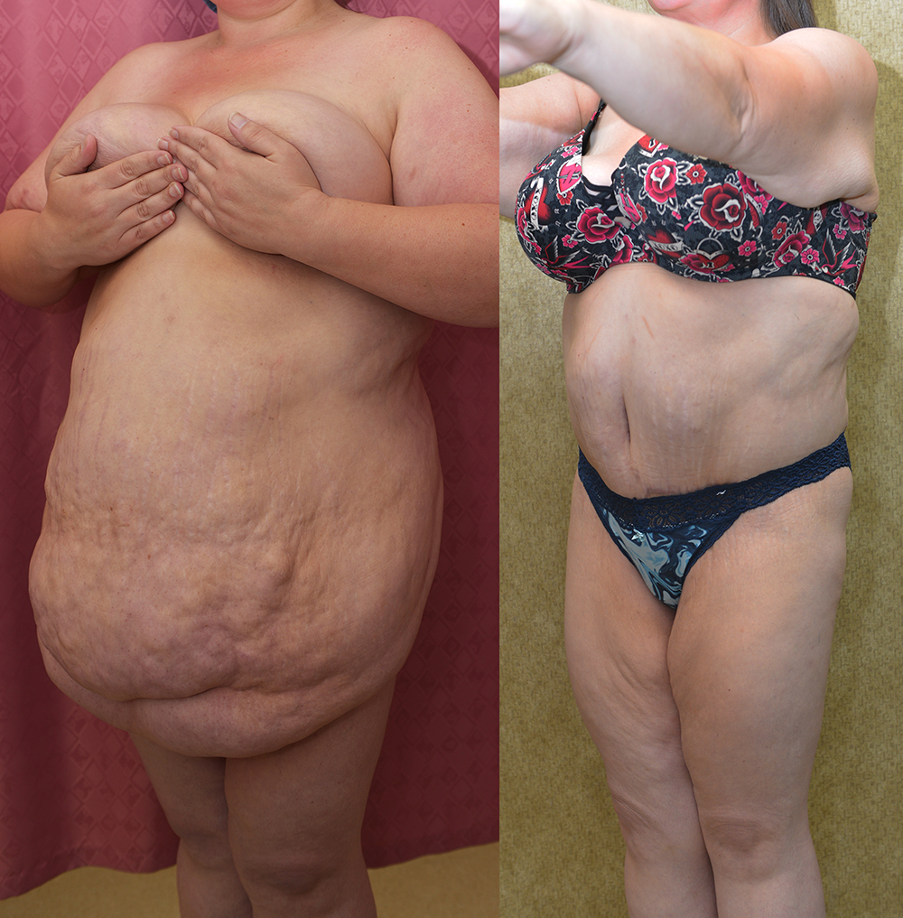 Tummy Tuck (Abdominoplasty) Super Plus Size Before & After Patient #14406
