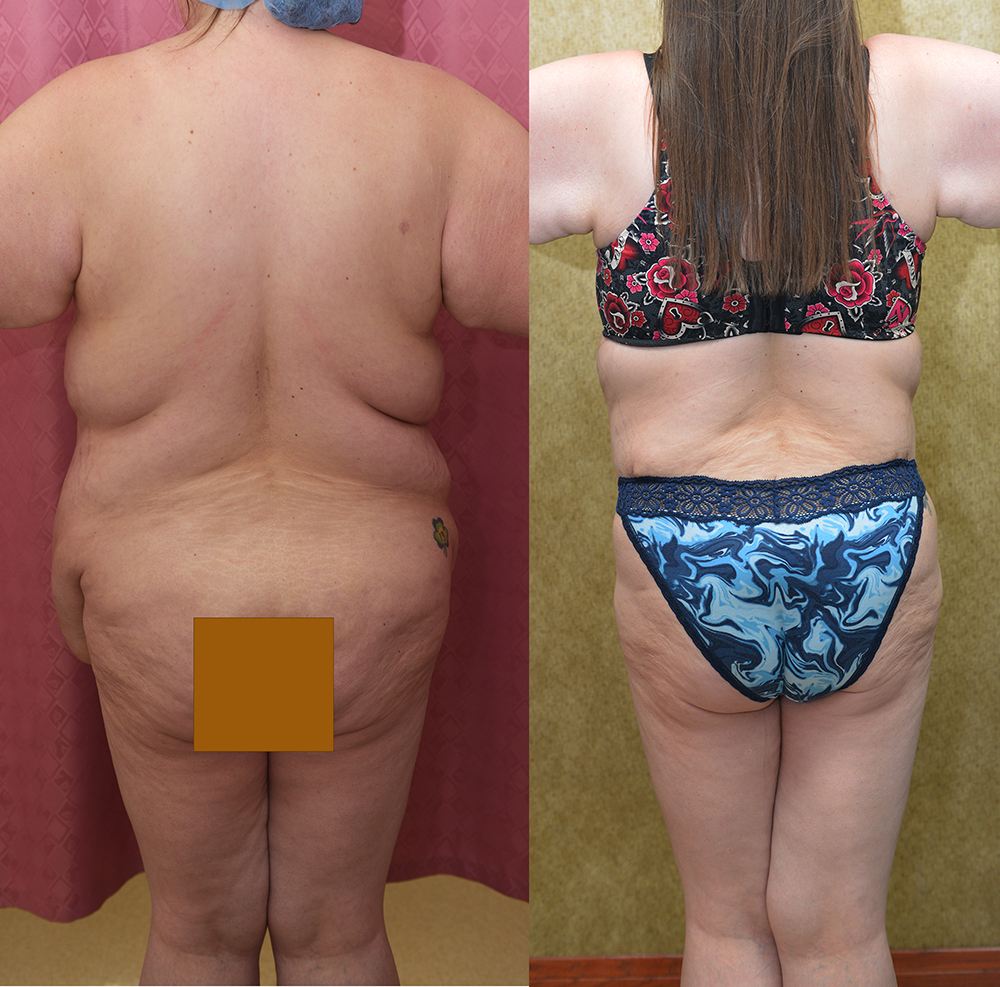 Tummy Tuck (Abdominoplasty) Super Plus Size Before & After Patient #14406
