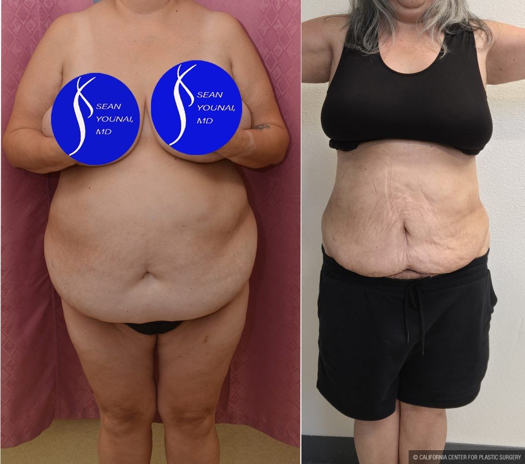 Liposuction Abdomen Plus Size Before & After Patient #14528