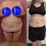 Liposuction Abdomen Plus Size Before & After Patient #14528