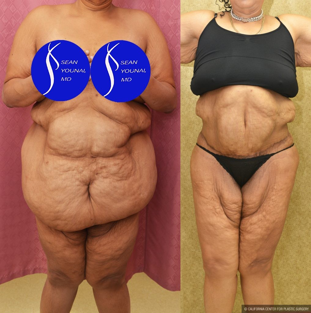Tummy Tuck (Abdominoplasty) Super Plus Size Before & After Patient #14530